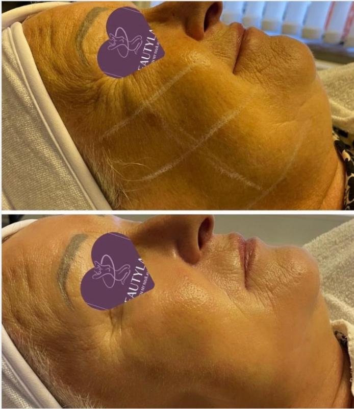 Avant après soin visage Beauté Paris